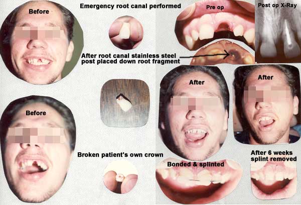 Before and After Emergency Root Canal Treatment