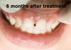 6 months after root canal treatment