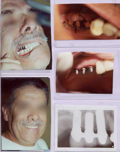 After implants were in place