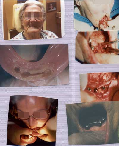 Elederly woman having 4 implants inserted into bottom row