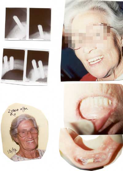 Before & after 2 years later of dental implants