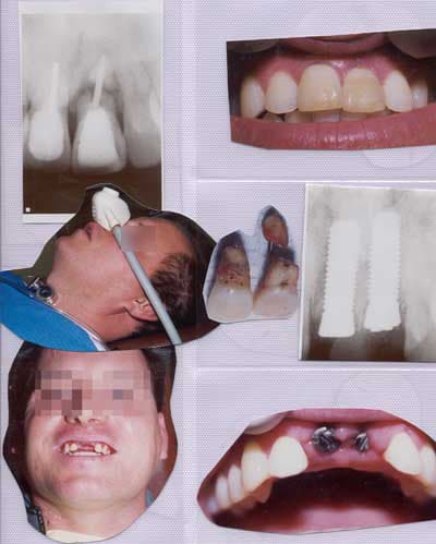 Foundation for implants set in gums for 2 front teeth