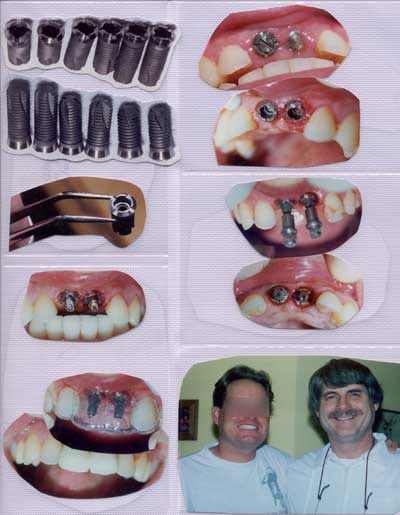 pictures of copleted implants for 2 front teeth