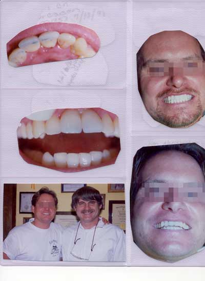 Dental implants for front teeth