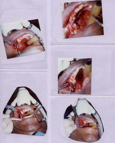 Preparation of gums for installation of dental implants