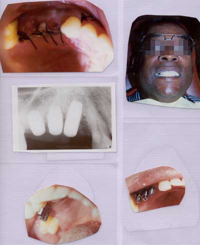 Dental implant treatment from start to finish
