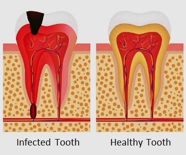 Infecciones Dentales, Quistes, Abcesos
