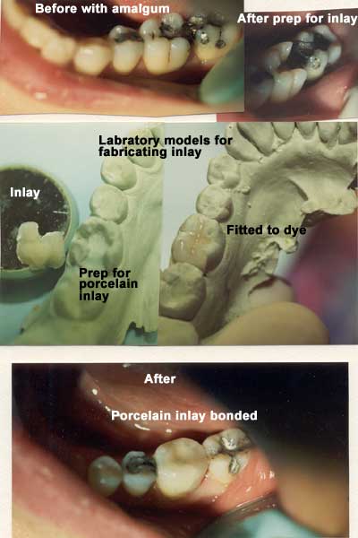 Restauración dental con incrustaciones de porcelana