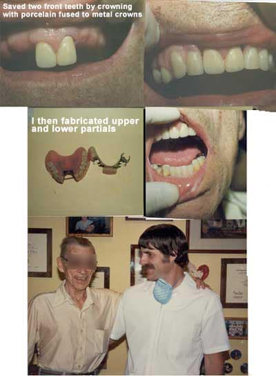 Fabricated upper and lower partial dentures