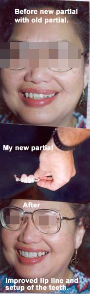 Before & after of partial dentures