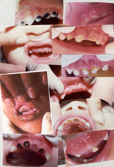 Caries dental pediátrica grave