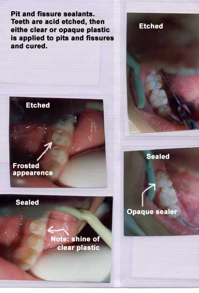 Before and After Pit and fissure sealants