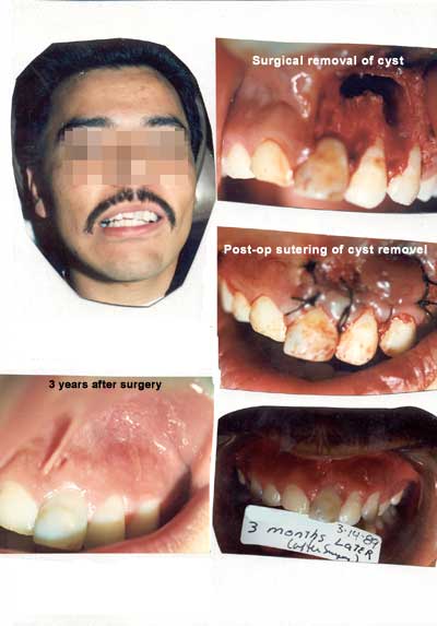 Cirugía oral. Extirpación quirúrgica del quiste