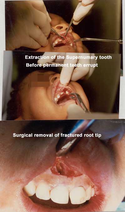 Extracción del diente supernumerario antes de que erupcionen los dientes permanentes