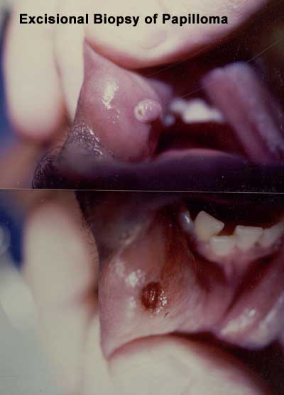 Biopsia escisional de papiloma