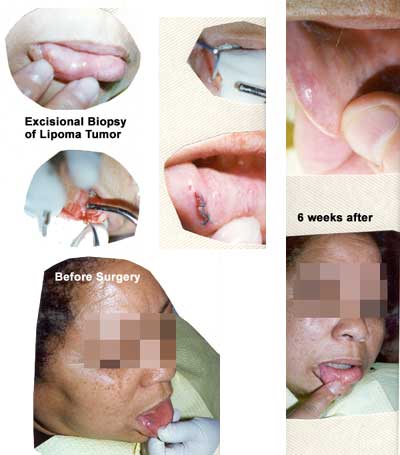 Biopsia escisional del tumor lipoma