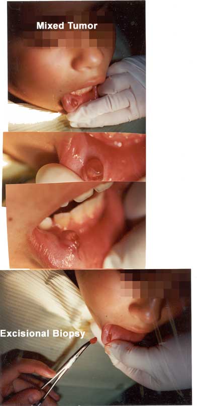 Cirugía oral, biopsia excisional de tumor mixto