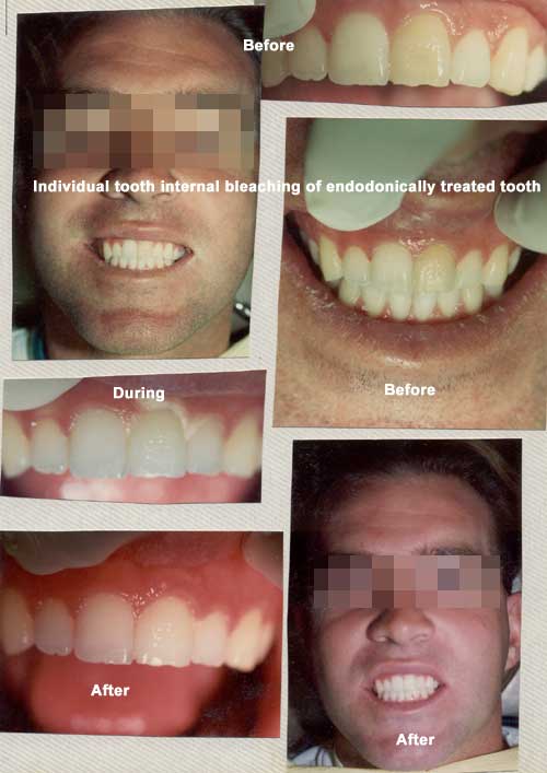 Internal Bleaching teeth whitening