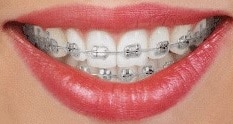 Traditional metal braces available at Carson & Carson, DDS in Oxnard, California.