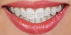 Ceramic braces available from Carson & Carson, DDS in Oxnard, California.