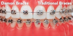 Damon vs traditional braces. Available at Oxnard dentist Carson & Carson, DDS.