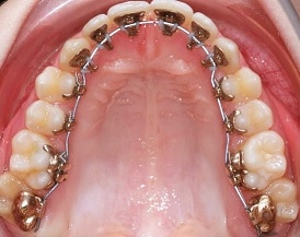Lingual braces available at Oxnard dentist Carson & Carson, DDS.