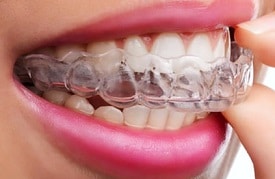 Invisalign clear aligners are an easy to use alternative to braces. Available at Oxnard dentist Carson & Carson, DDS.